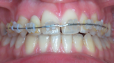 orthodontie 93