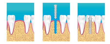 Implants dentaires Pré-Saint-Gervais 